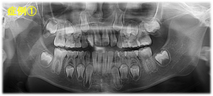 レントゲン 乳歯 年齢別のパノラマX線写真