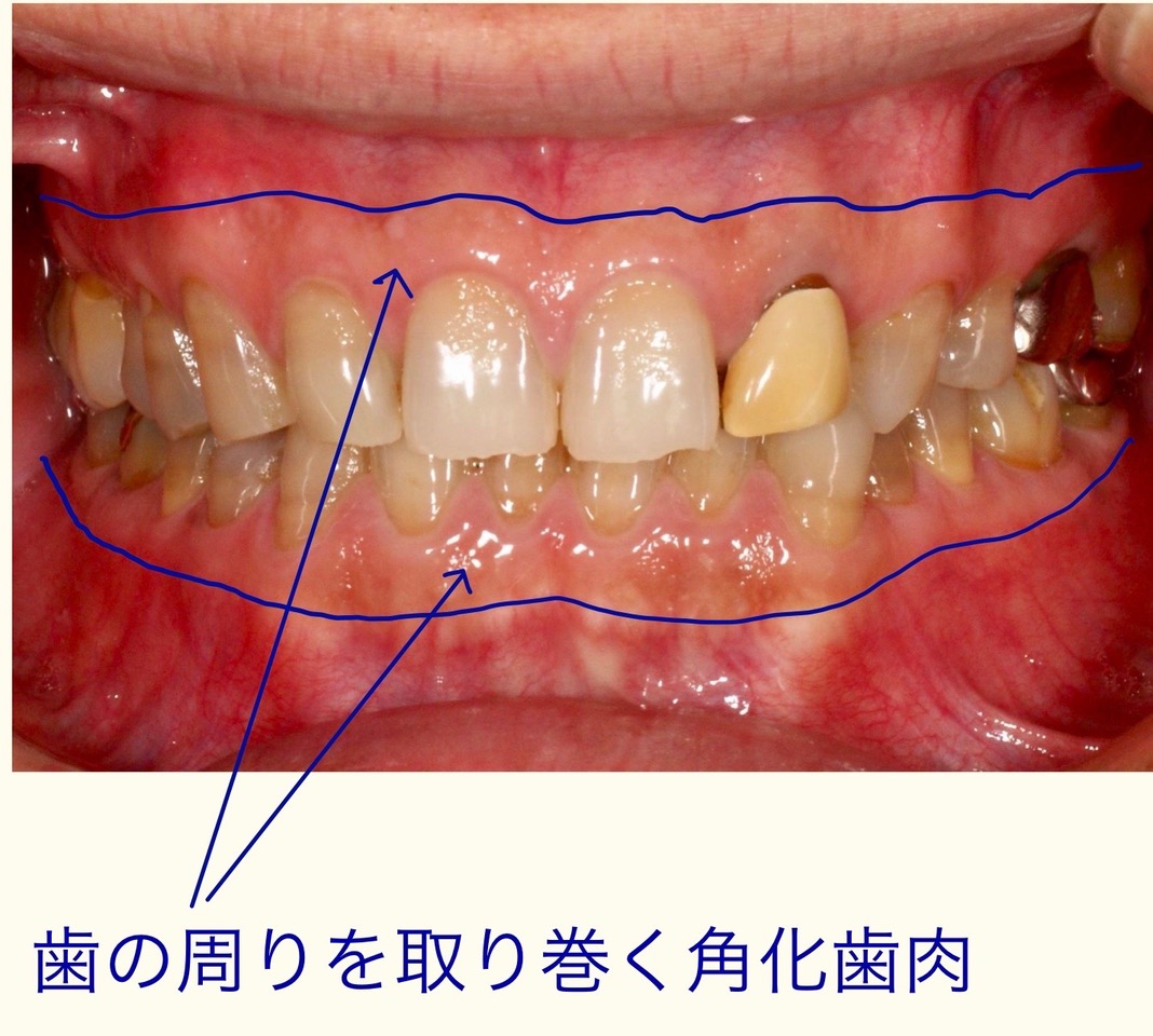 歯周病が進みにくくなる 角化歯肉 について 吹田市の歯医者 歯科医院ならきじま歯科医院