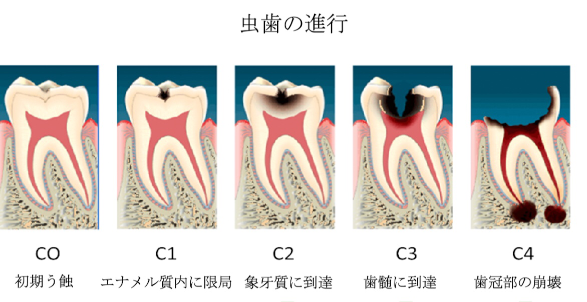 虫歯の進行度合い 吹田市の歯医者 歯科医院ならきじま歯科医院