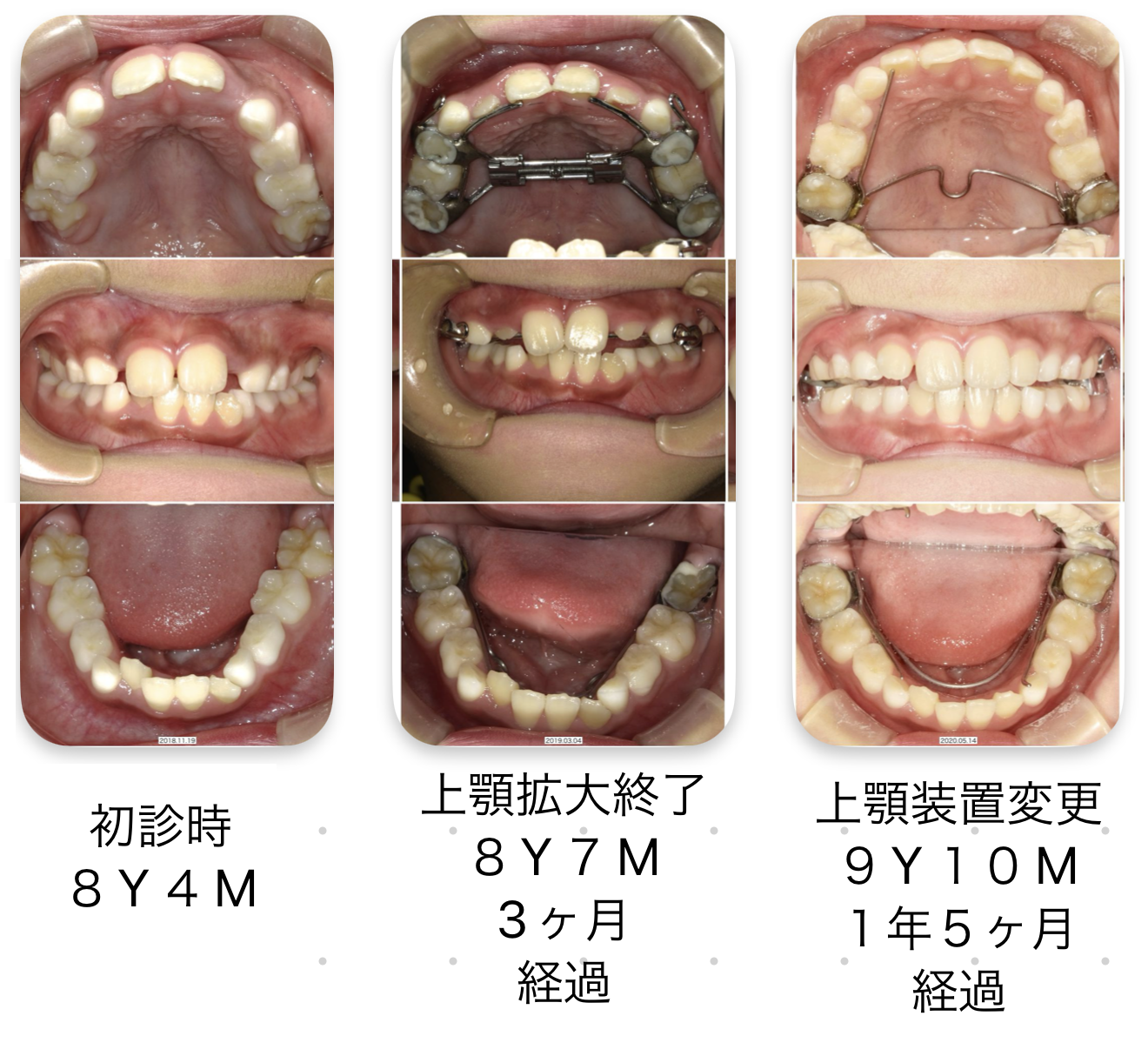 顎顔面矯正症例 | 吹田市の歯医者・小児歯科ならきじま歯科医院